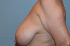 Patient Breast Augmentation Mastopexy Thumbnail Before 2