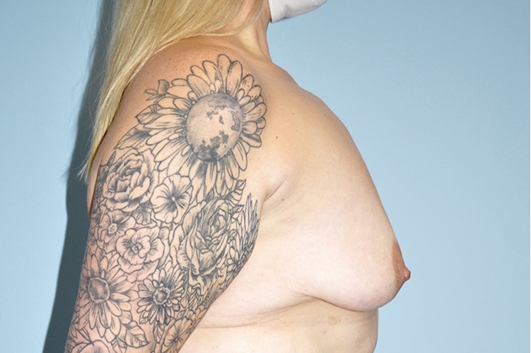 Patient Breast Augmentation Mastopexy Before 2