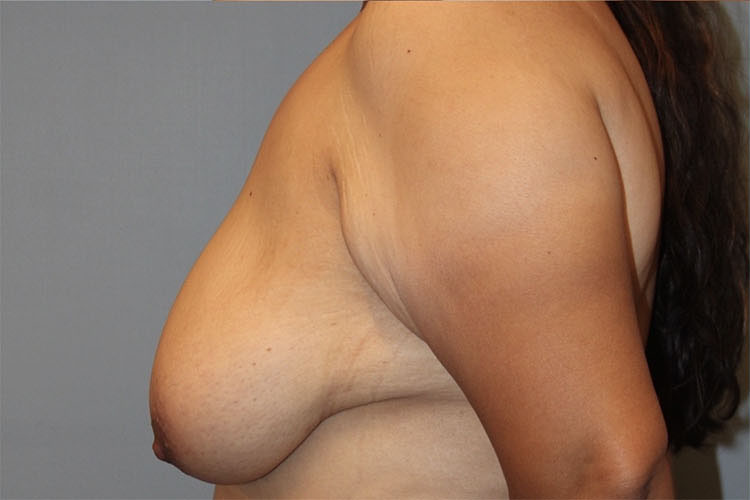 Patient Breast Lift Before 2