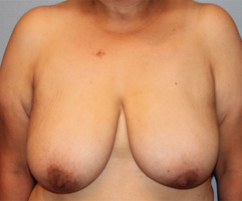 Patient Breast Reduction Before 0