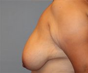 Patient Breast Reduction Thumbnail Before 2