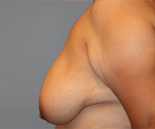Patient Breast Reduction Before 2