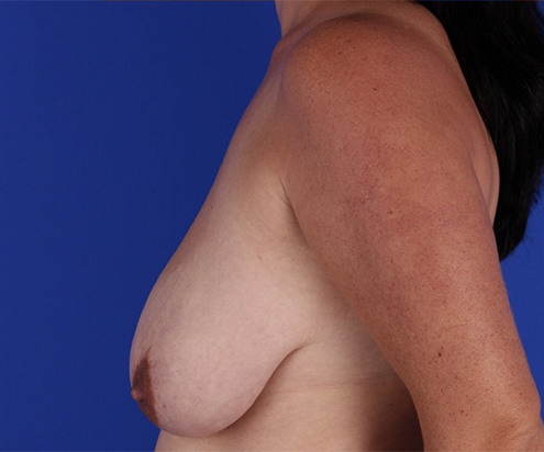 Patient Breast Reduction Before 2
