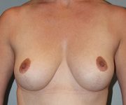 Patient Breast Reduction Thumbnail After 0