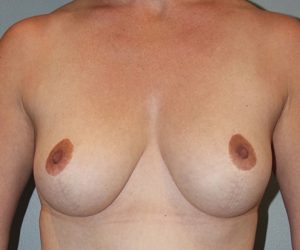 Patient Breast Reduction After 0