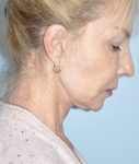 before facelift side view female case 3855