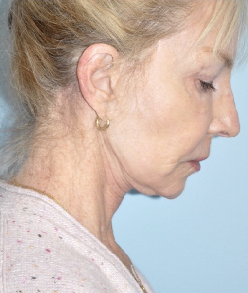 Patient Facelift Before 2