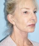 before facelift angle view female case 3855