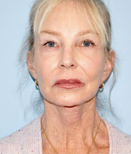 before facelift front view female case 3855