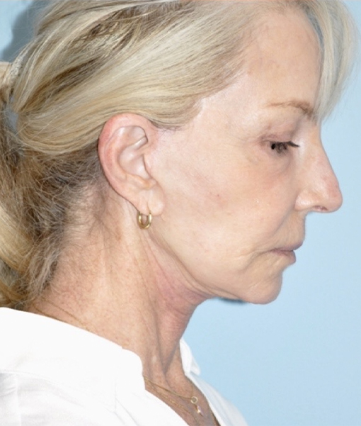 Patient Facelift Before 2