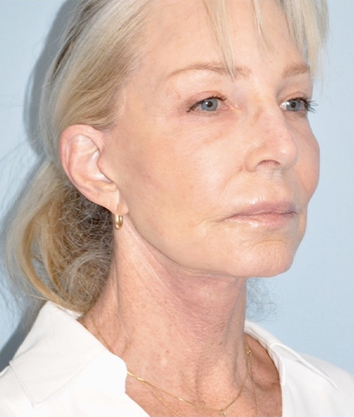 Patient Facelift Before 1