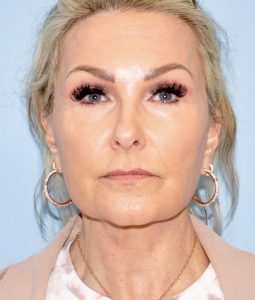 Patient Facelift After 0