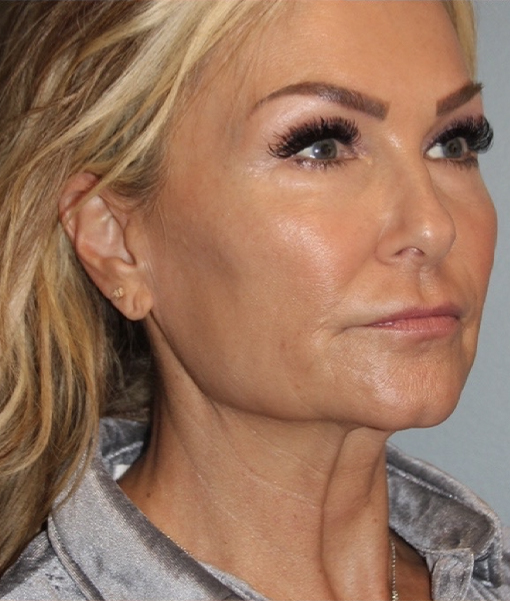 before facelift angle view female case 3869