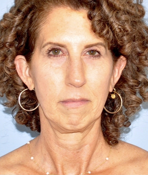 Patient Facelift Before 0