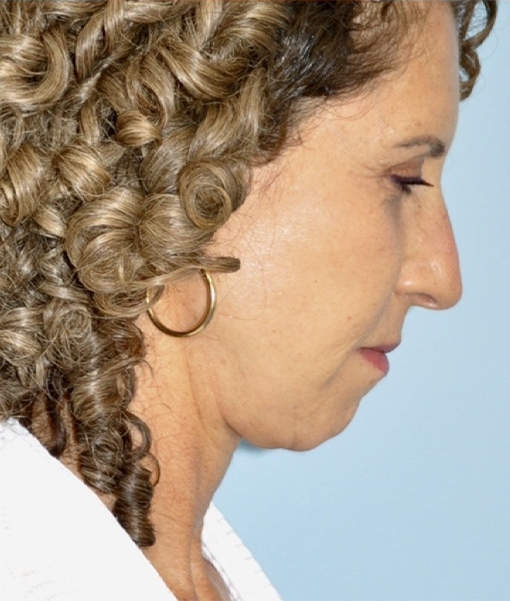 Patient Facelift Before 2