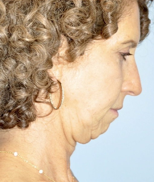 before neck lift side view female case 3890