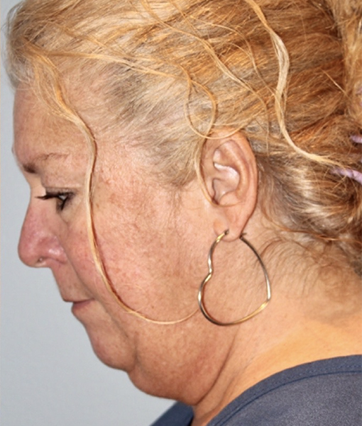 Patient Facelift Before 2