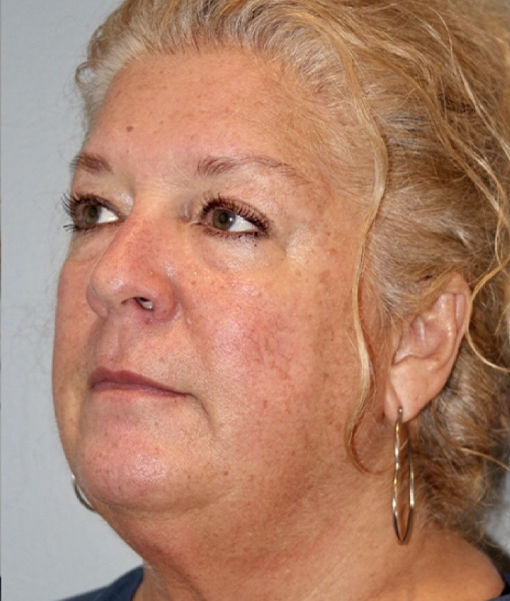 before facelift angle view female case 3911