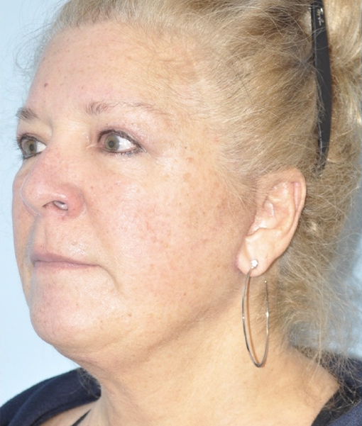 Patient Facelift Before 1