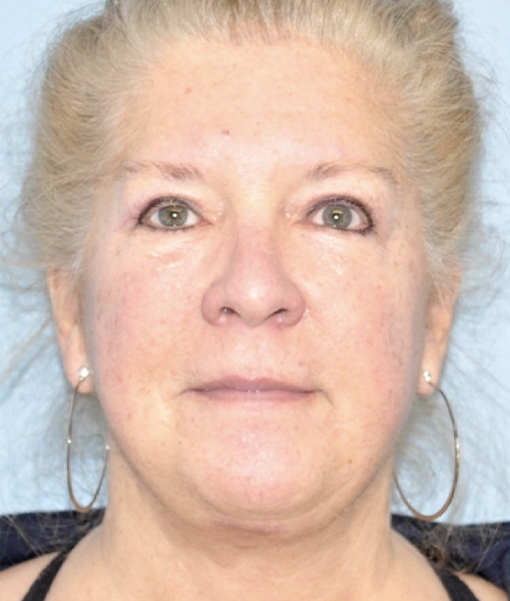 Patient Facelift Before 0