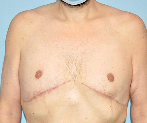 after gynecomastia front view case 3841