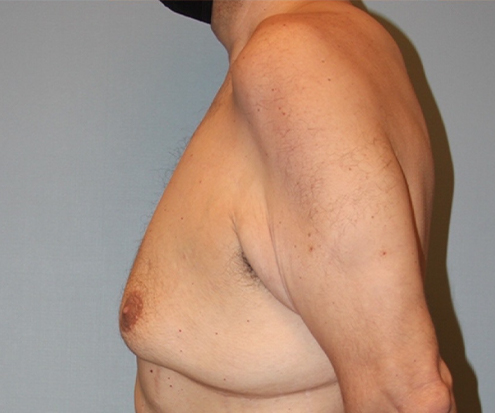 before gynecomastia side view case 3841