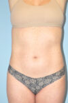 before liposuction female patient front angle view Case 3692