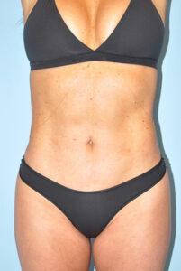 after liposuction female patient front angle view Case 3692