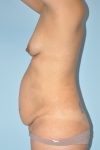 before tummy tuck side view female patient case 3932