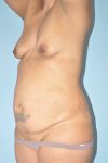 before tummy tuck angle view female patient case 39396