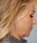 before neck lift side view female case 3876