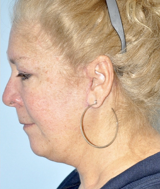 after neck lift side view female case 3904