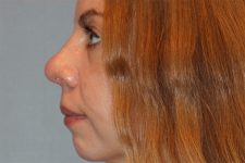 Patient Rhinoplasty Thumbnail After 1