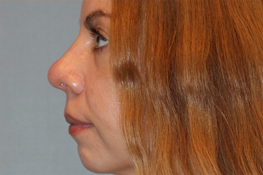 Patient Rhinoplasty Before 1