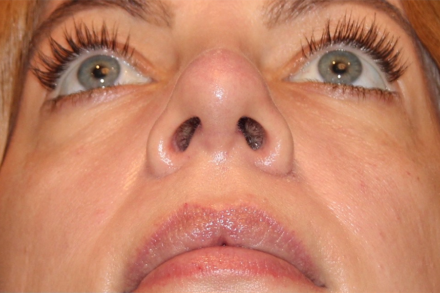 after rhinoplasty under view female patient case 3848