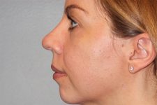 Patient Rhinoplasty Thumbnail Before 1