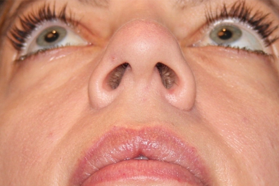 Patient Rhinoplasty Before 2