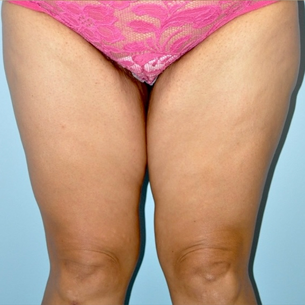 after Thigh Lift female patient front angle view Case 3443