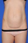 before tummy tuck female patient front view