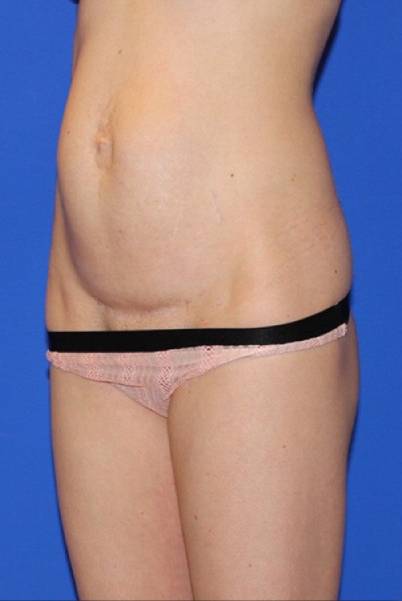 before tummy tuck female patient diagonal view