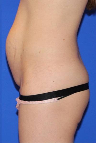 before tummy tuck female patient side view