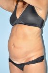 before tummy tuck angle view female patient case 3946