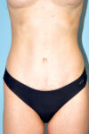 after tummy tuck front view female patient case 2730