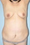 Patient Tummy Tuck Thumbnail Before 0