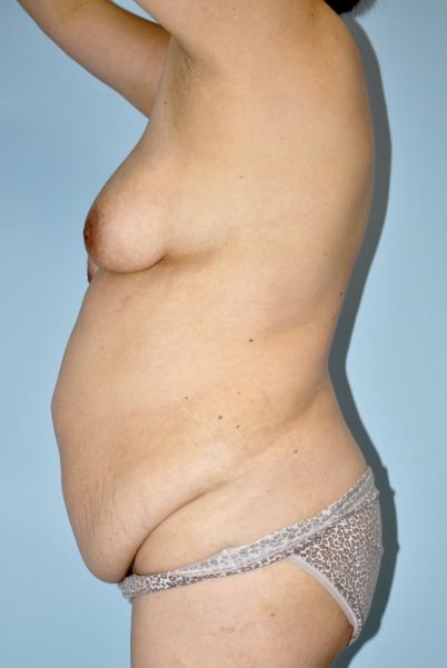 Patient Tummy Tuck Before 2