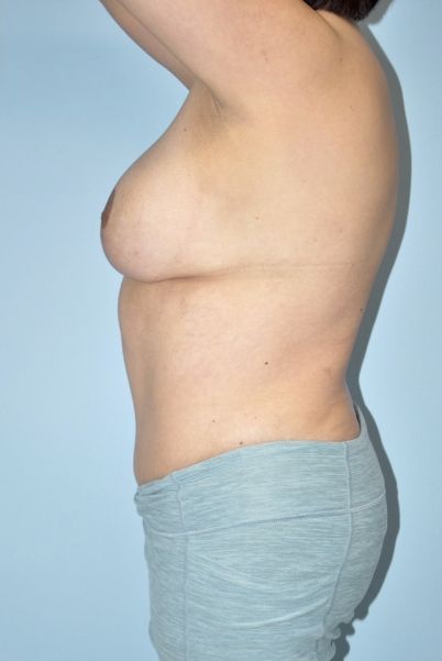 Patient Tummy Tuck Before 2