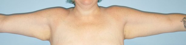 Patient Brachioplasty | Arm Lift Thumbnail Before 0