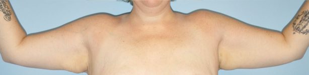 Patient Brachioplasty | Arm Lift Thumbnail Before 1