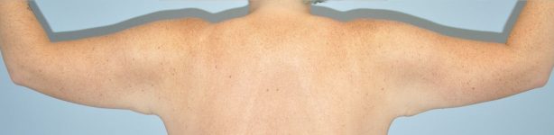 Patient Brachioplasty | Arm Lift Thumbnail Before 3