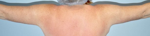 Patient Brachioplasty | Arm Lift Thumbnail After 2